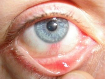 Флебопатия сетчатки обоих глаз у новорожденного