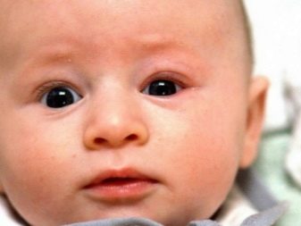 Блефарит у ребенка фото глаза лечение