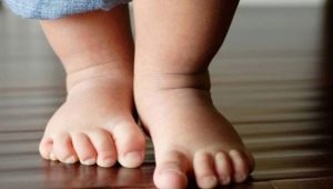 Вальгусная деформация стоп у детей