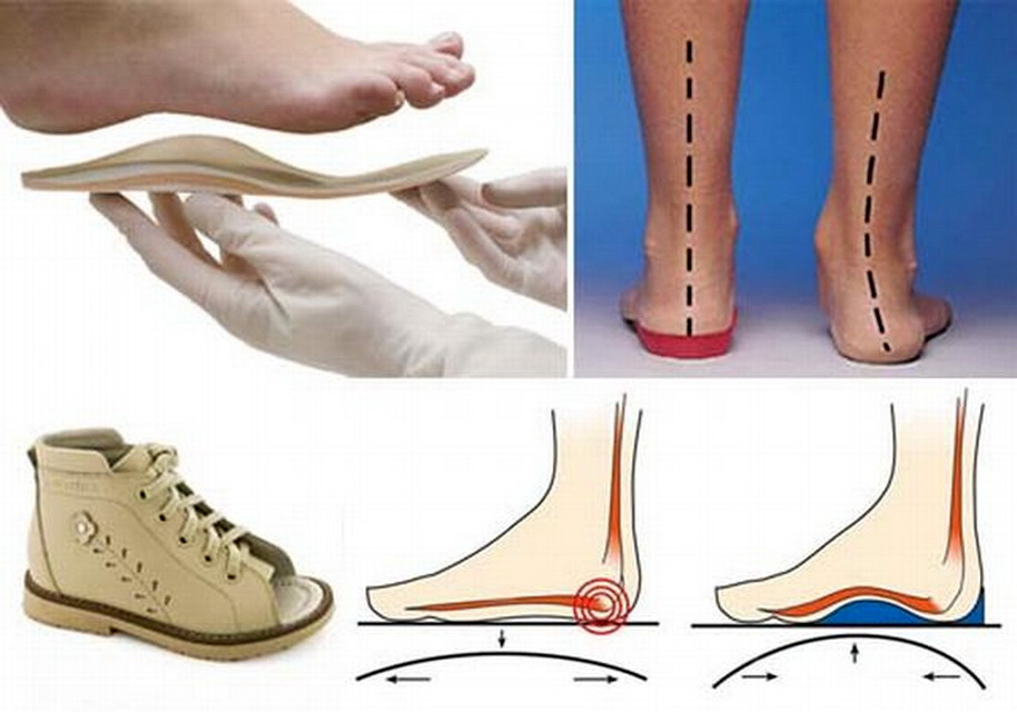 Как подобрать ортопедическую обувь. Вальгусная деформация стельки. Плоскостопие вальгусная стопа стельки. Супинаторы для стопы при вальгусной деформации. Обувь от плоскостопия.