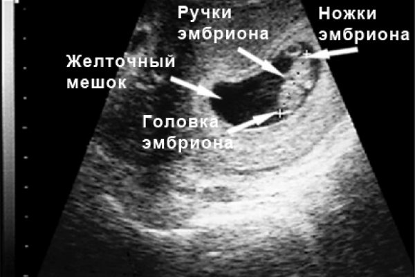 Эмбрион на 8 неделе беременности фото узи