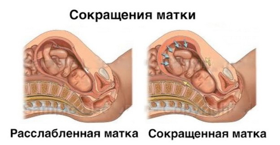 Беременность сокращения. При тонусе матки при беременности. Тонус матки при беременности 2 триместр. Тонус матки приибеременрости. Гипертонус матки.