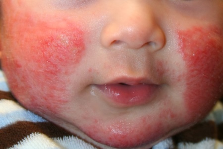 Атопический дерматит у ребенка лечение народными средствами thumbnail