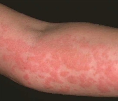 Диф диагностика аллергического дерматита