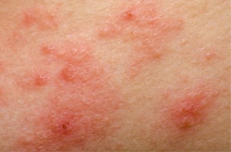 Дифференциальный диагноз аллергического дерматита