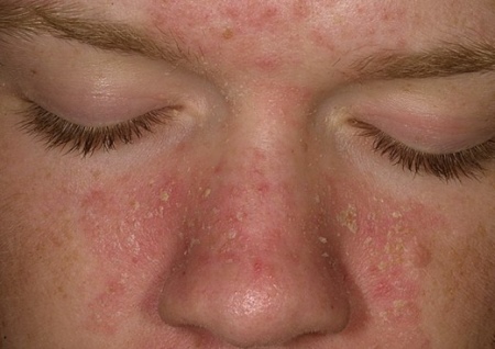Дифференциальный диагноз аллергического дерматита thumbnail