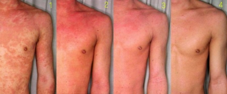 Эритематозно сквамозная форма атопического дерматита у thumbnail