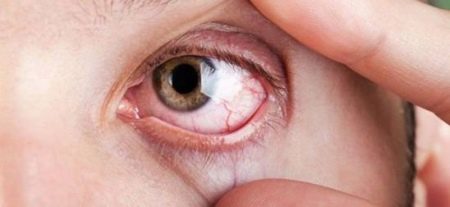 Что такое флебопатия сетчатки глаз у новорожденных