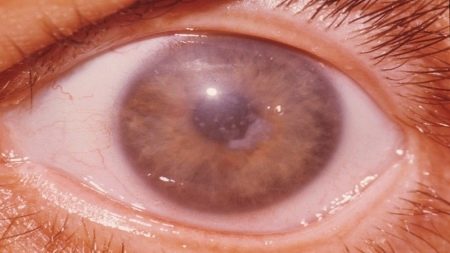 Флебопатия сетчатки обоих глаз у новорожденного