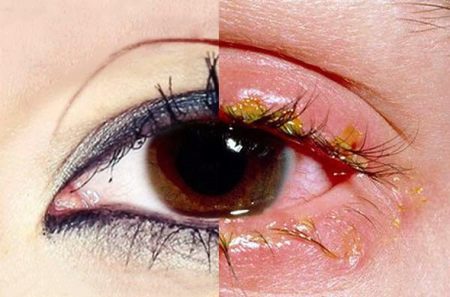 Блефарит у ребенка фото глаза лечение