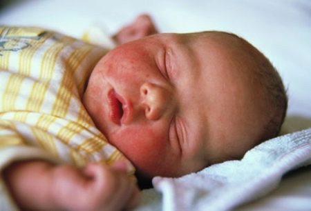 Как вылечить золотистый стафилококк у новорожденных
