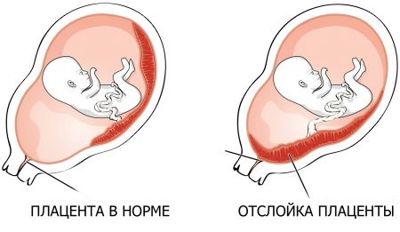 Узи на 5 неделе беременности акушерской неделе беременности