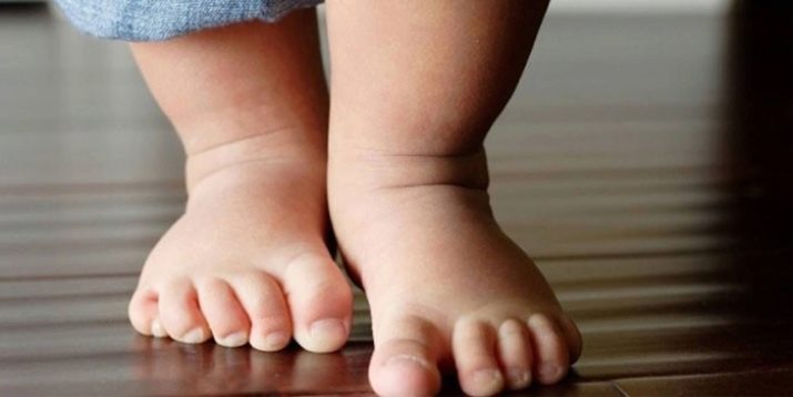 Аномалия развития стопы у ребенка